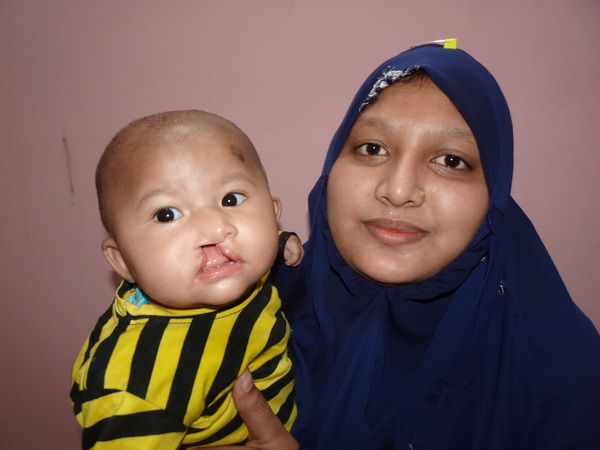 feeding a child with cleft lip guide